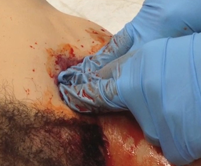 Inguinal Cease Wound Package TacMed Clinical Response Lower (CRL)